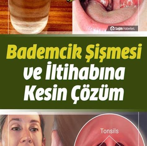 Bademcik iltihabına Ne İyi Gelir?