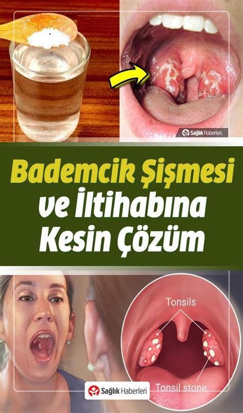 Bademcik iltihabına Ne İyi Gelir?