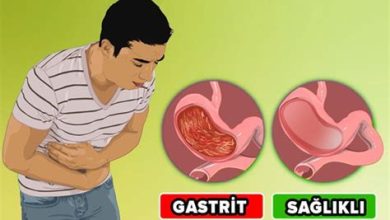 GASTRİT NEDİR? GASTRİT BELİRTİLERİ NELERDİR?