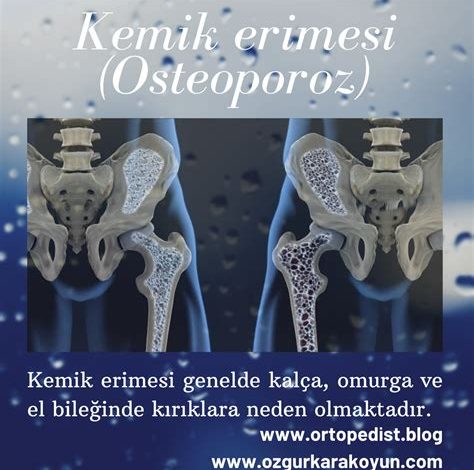 Kemik erimesi (Osteoporoz)